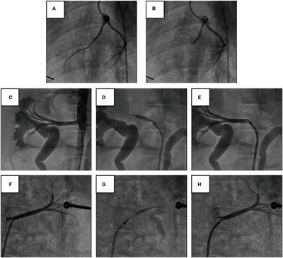 Immediate Renal Denervation After Acute Myocardial Infarction Mitigates the Progression of Heart Failure via the Modulation of IL-33/ST2 Signaling